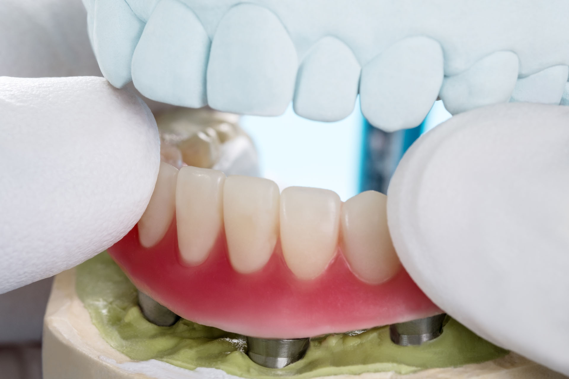 https://shifadentalclinic.in/wp-content/uploads/2020/01/implant-supported-overdenture.jpg