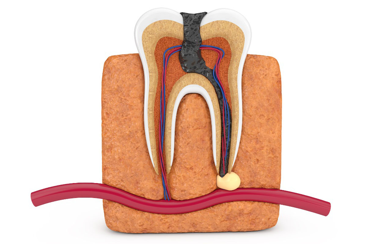 https://shifadentalclinic.in/wp-content/uploads/2020/01/rootcanal_treatment_img.jpg