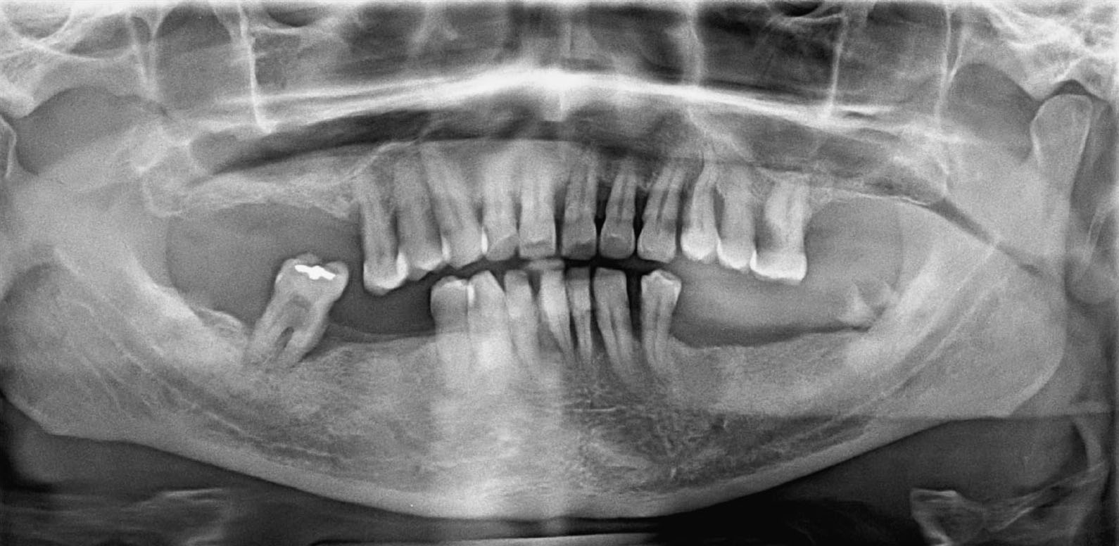 Chronic generalised periodontitis (Advanced stage of gum disease)