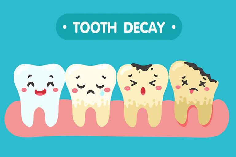 https://shifadentalclinic.in/wp-content/uploads/2022/08/Tooth_-Decay.jpg
