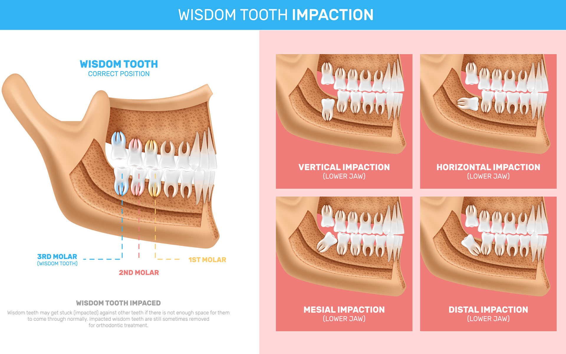 wisdom tooth impaction