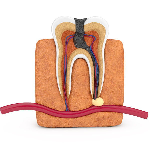 https://shifadentalclinic.in/wp-content/uploads/2022/10/ROOTcanal-therapy.jpg