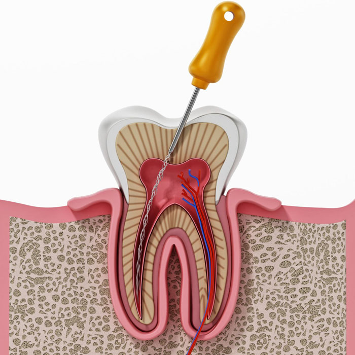 https://shifadentalclinic.in/wp-content/uploads/2022/10/root_canal.jpg