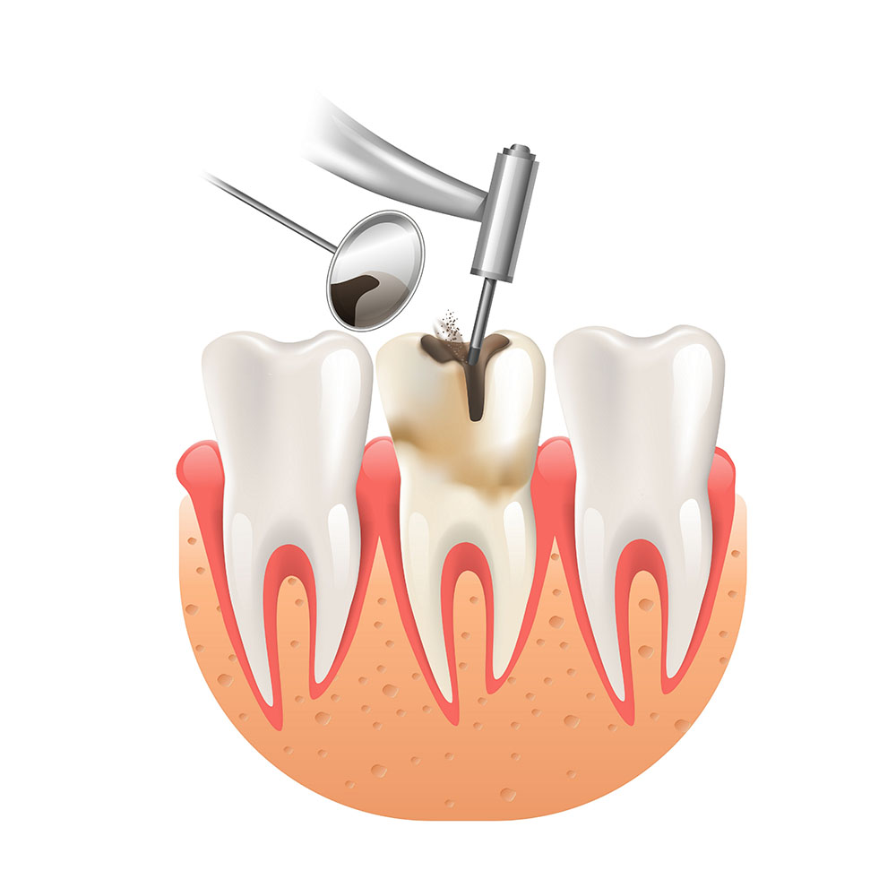Clean Caries by Tooth Dental Drill. 3d Realistic Vector Illustration of Dentistry Health Care.