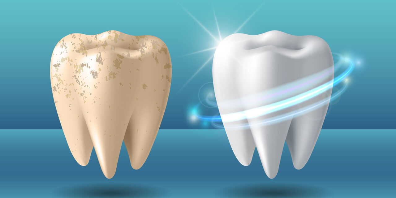 Teeth Cleaning or Scaling